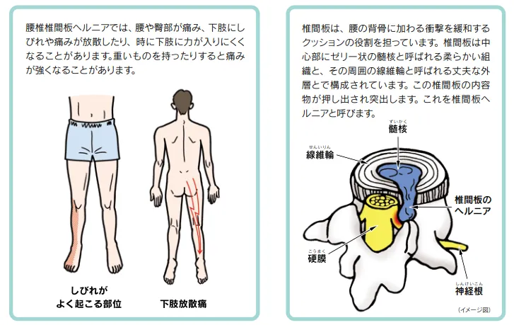 椎間板ヘルニアの説明